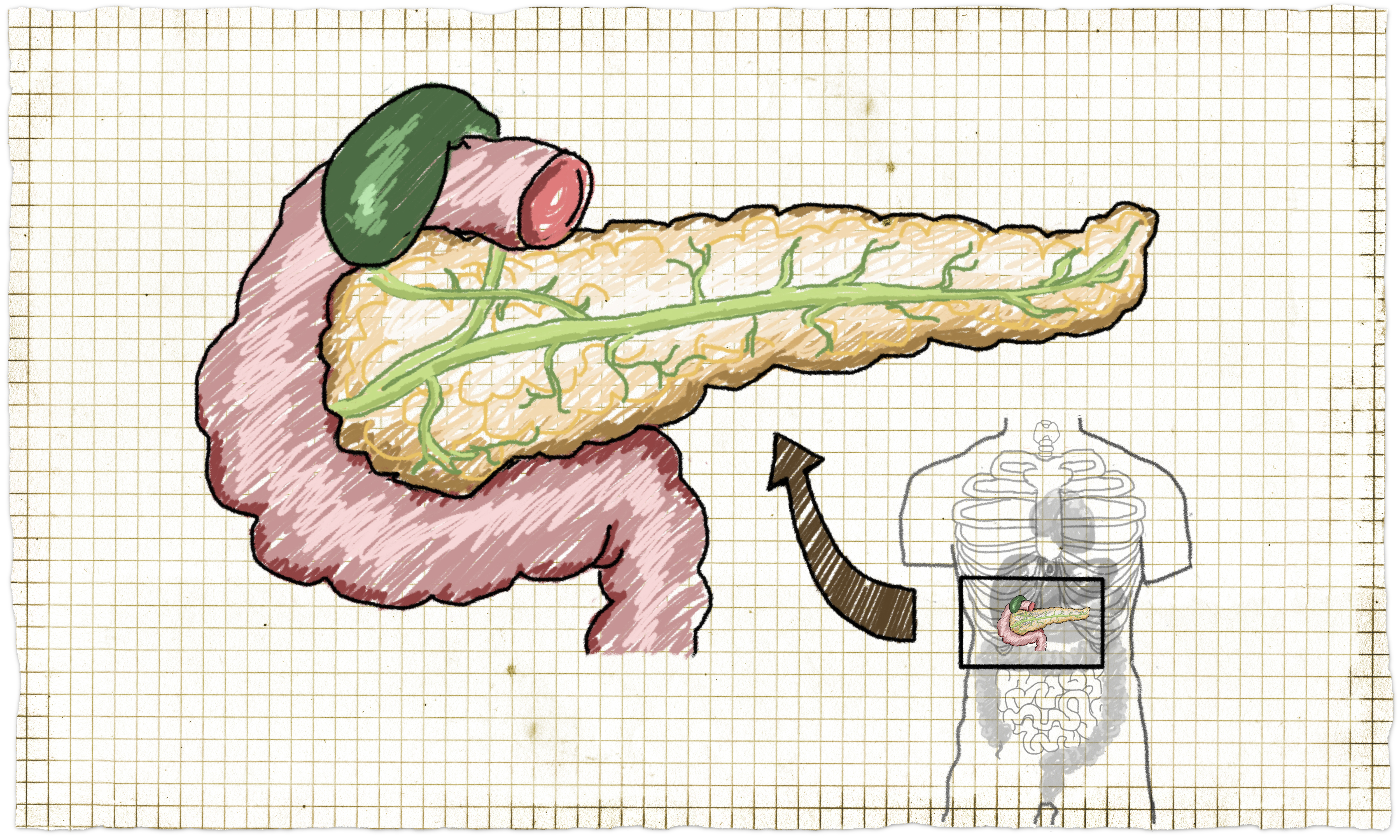 Image for Maturity Onset Diabetes of the Young (MODY)