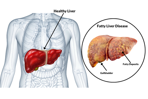 Showing healthy liver and fatty liver